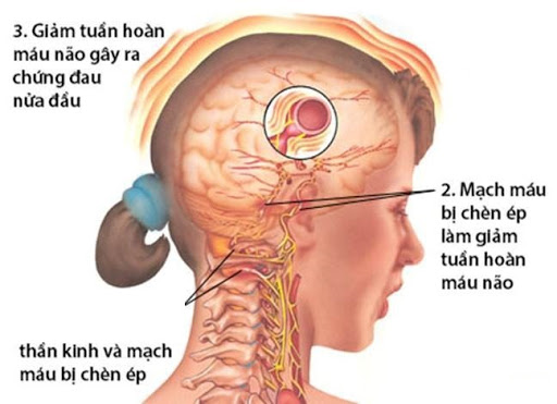 Thoái hóa đốt sống cổ có nguy hiểm hay không?
