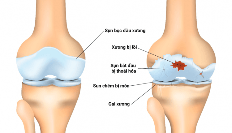 Tại sao sụn khớp bị bào mòn, nứt vỡ?