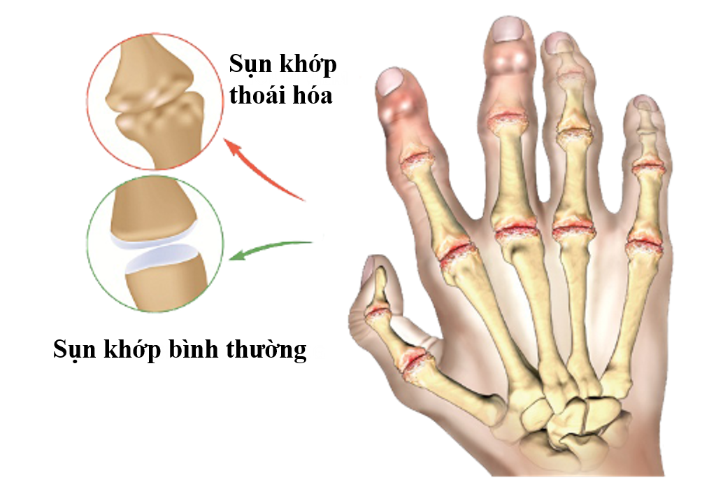 đau khớp ngón tay do thoái hóa khớp bàn ngón tay