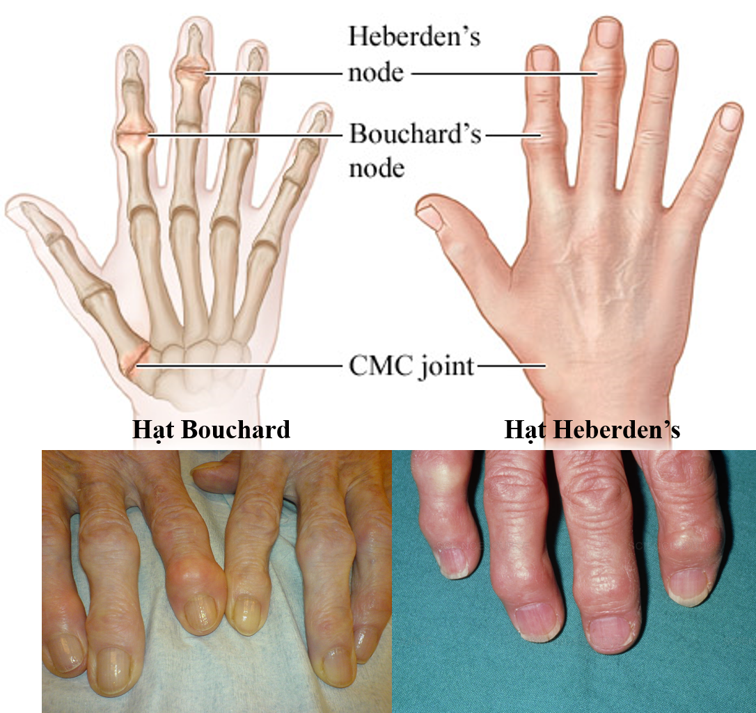 biểu hiện thay đổi bàn tay do thoái hóa khớp ngón tay