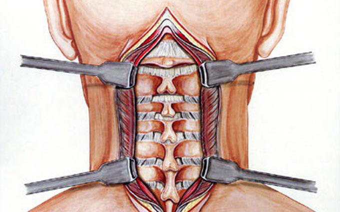 4. Phương Pháp Điều Trị Thoái Hóa Đốt Sống Cổ