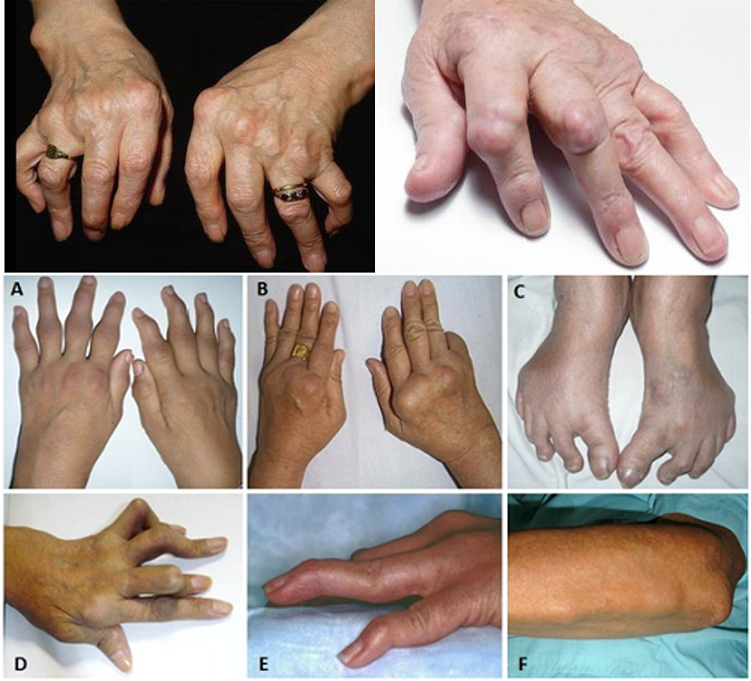 Dấu hiệu của bệnh viêm khớp