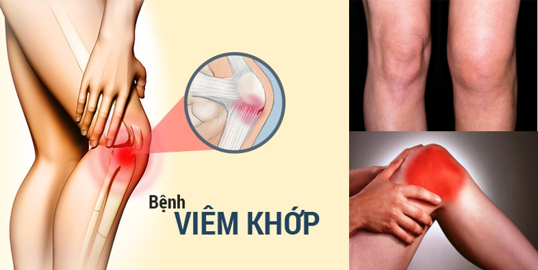 Dấu hiệu của bệnh viêm khớp
