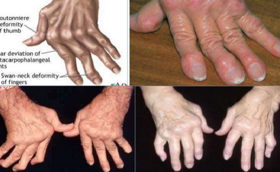 Viêm khớp có chữa được không