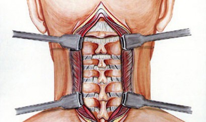 Khi nào cần phẫu thuật thoái hóa cột sống?