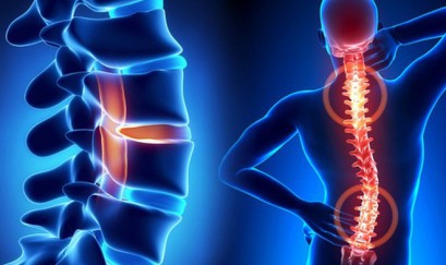 thoái hoá cột sống